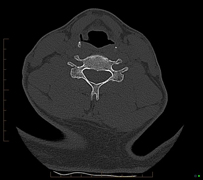 File:Accessory articulation of cervical transverse processes (Radiopaedia 82715-96933 Axial non-contrast 84).jpg