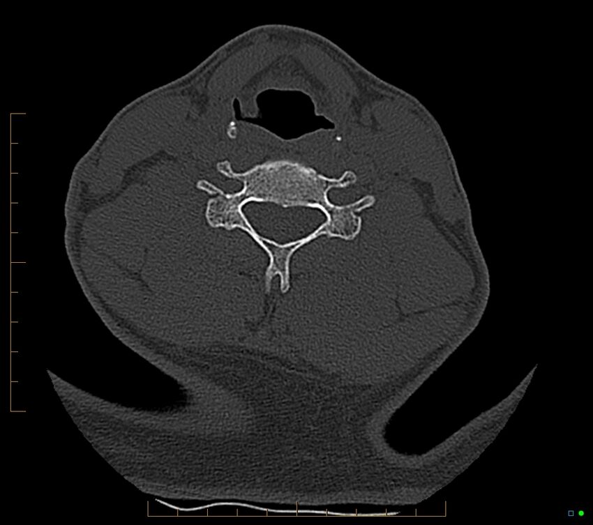 Accessory articulation of cervical transverse processes (Radiopaedia 82715-96933 Axial non-contrast 84).jpg