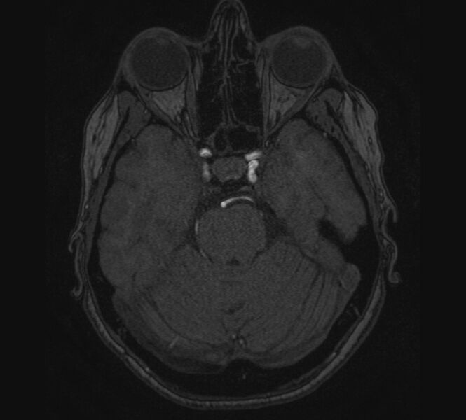 File:Accessory middle cerebral artery and ICA aneurysm (Radiopaedia 22656-22674 MRA 29).jpg