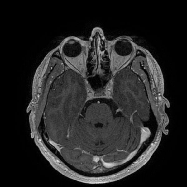 File:Acoustic schwannoma - intracanalicular (Radiopaedia 37247-39024 Axial T1 C+ 85).jpg
