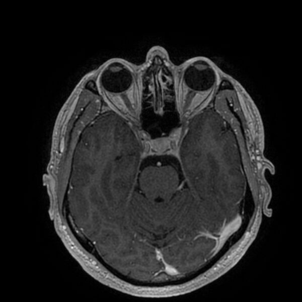 File:Acoustic schwannoma - intracanalicular (Radiopaedia 37247-39024 Axial T1 C+ 92).jpg