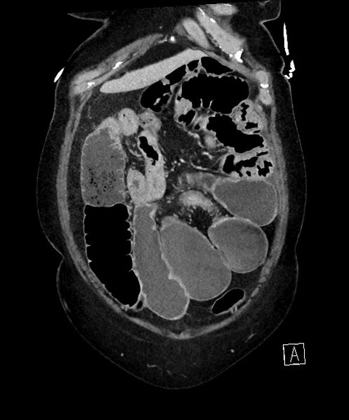 File:Active Crohn disease (Radiopaedia 59394-66750 Coronal C+ portal venous phase 19).jpg