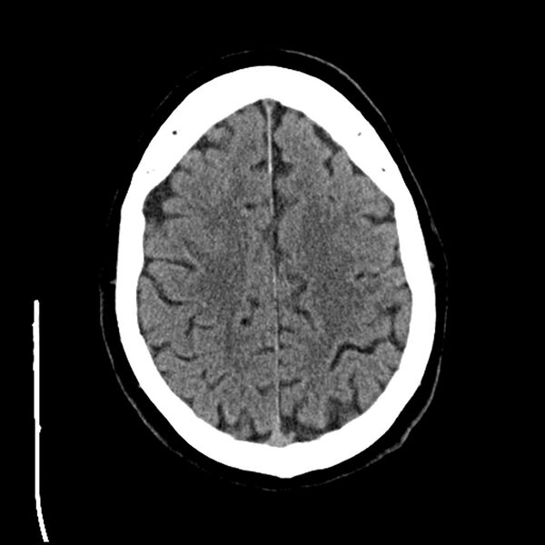 File:Acute A3 occlusion with ACA ischemic penumbra (CT perfusion) (Radiopaedia 72036-82525 Axial non-contrast 34).jpg