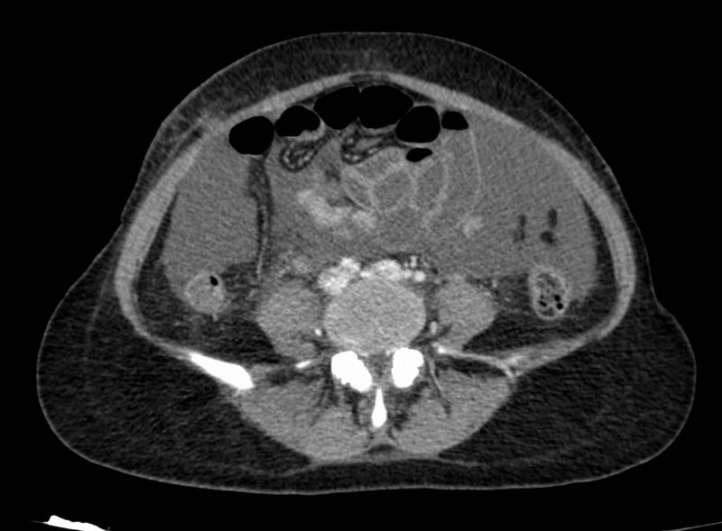 File:Acute Budd-Chiari syndrome (Radiopaedia 60858-68638 Axial C+ portal venous phase 198).jpg