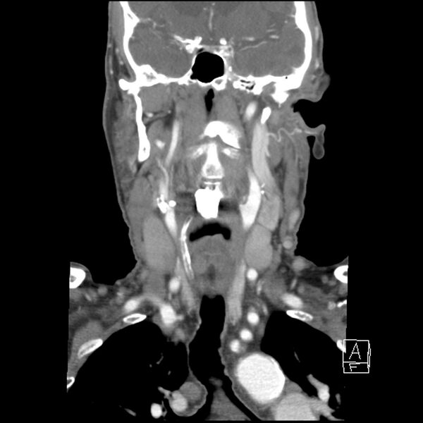 File:Acute ICA ischemic penumbra due to high-grade CCA stenosis (CT perfusion) (Radiopaedia 72038-82530 Coronal C+ arterial phase 19).jpg