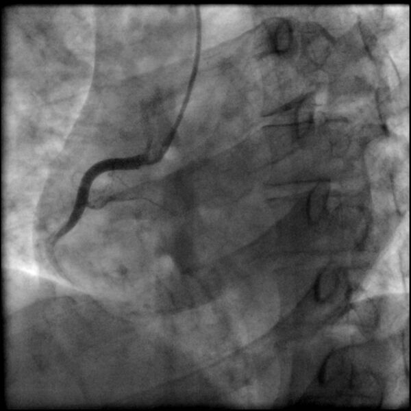 File:Acute anteroseptal myocardial infarction (Radiopaedia 68409-77946 RAO straight RCA 11).jpg