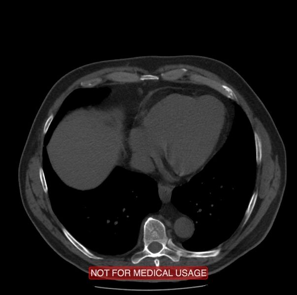 File:Acute aortic dissection - Stanford type A (Radiopaedia 40661-43285 Axial non-contrast 50).jpg