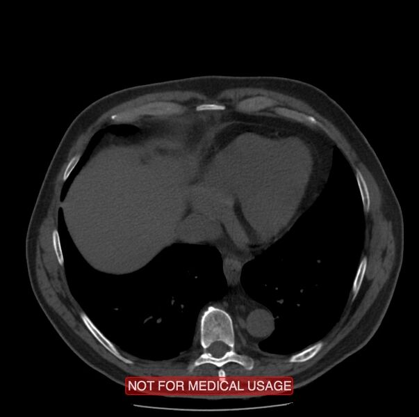 File:Acute aortic dissection - Stanford type A (Radiopaedia 40661-43285 Axial non-contrast 52).jpg