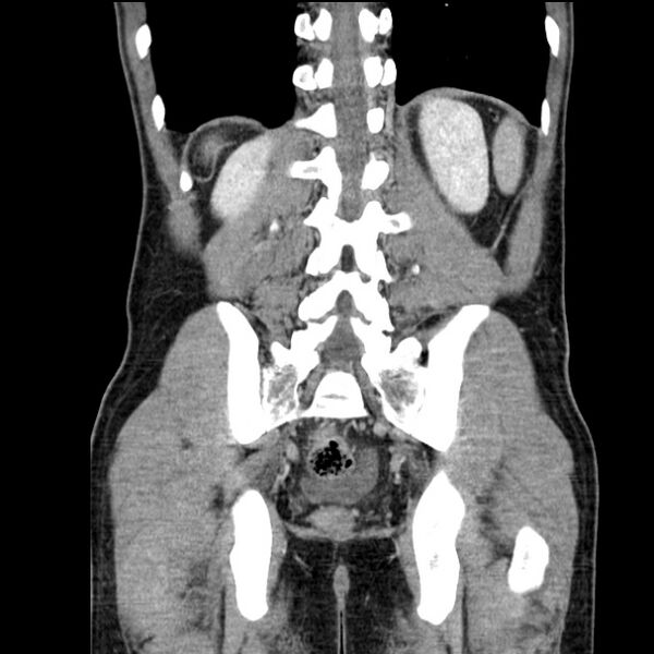 File:Acute appendicitis (Radiopaedia 27049-27227 Coronal C+ portal venous phase 44).jpg