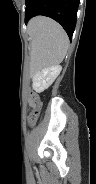 File:Acute appendicitis (Radiopaedia 62608-70901 Sagittal C+ portal venous phase 49).jpg
