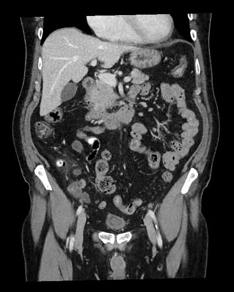 File:Acute appendicitis - large appendicoliths (Radiopaedia 61805-69820 Coronal C+ portal venous phase 55).jpg