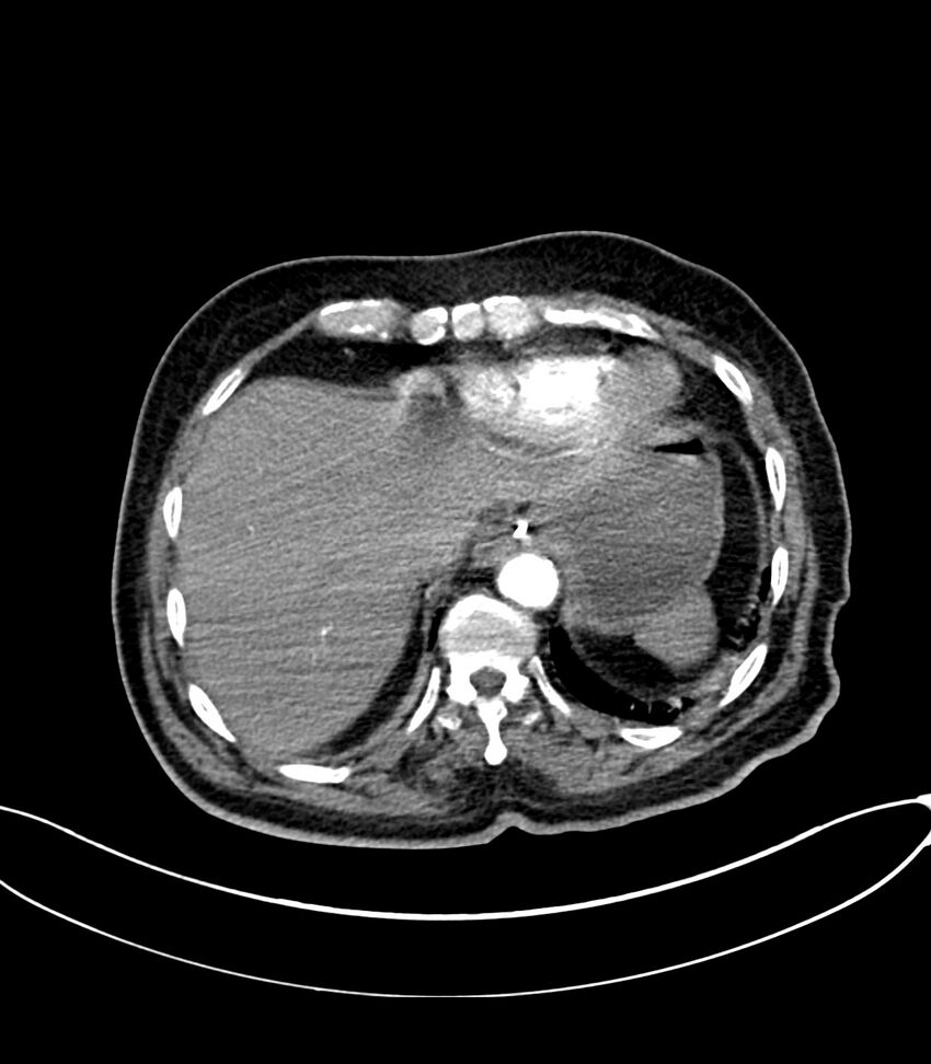 Acute arterial mesenteric ischemia (Radiopaedia 78238-90828 Axial C+ arterial phase 25).jpg