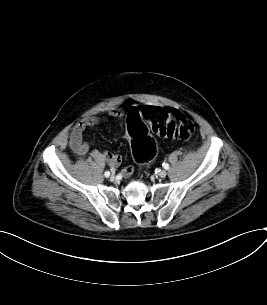 Acute arterial mesenteric ischemia (Radiopaedia 78238-90828 Axial C+ portal venous phase 111).jpg