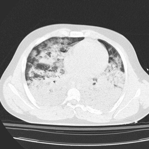 File:Acute aspiration pneumonitis (Radiopaedia 33605-34703 Axial lung window 56).jpg