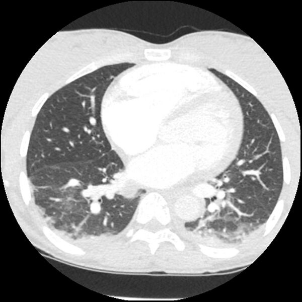 File:Acute chest syndrome - sickle cell disease (Radiopaedia 42375-45499 Axial lung window 115).jpg