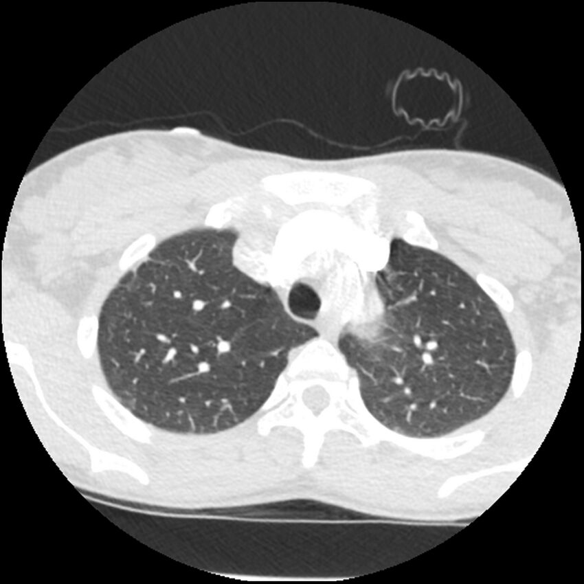 Acute chest syndrome - sickle cell disease (Radiopaedia 42375-45499 Axial lung window 47).jpg