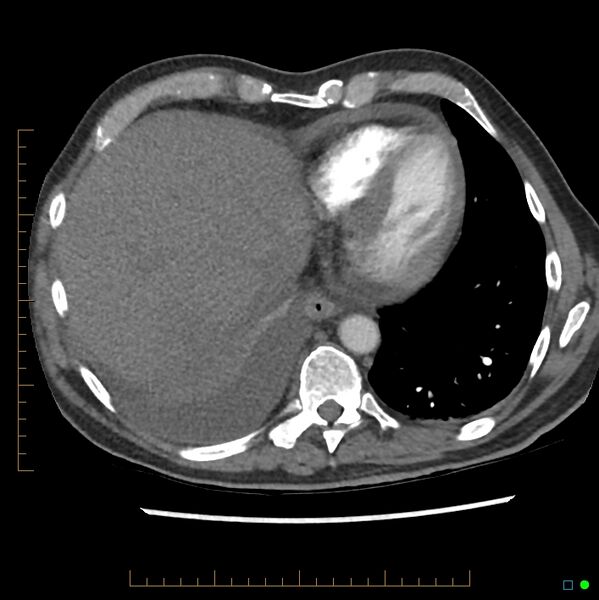 File:Acute hemorrhage into adrenal metastasis from NSCLC (Radiopaedia 43135-46429 Axial C+ CTPA 5).jpg