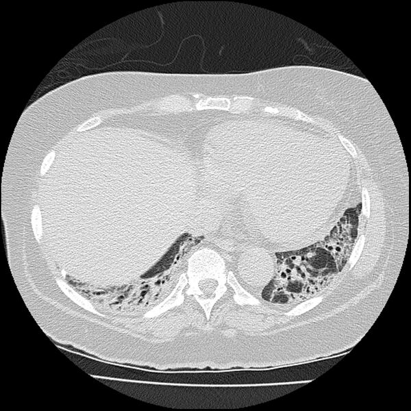 File:Acute interstitial pneumonitis (Radiopaedia 45404-49452 Axial lung window 68).jpg