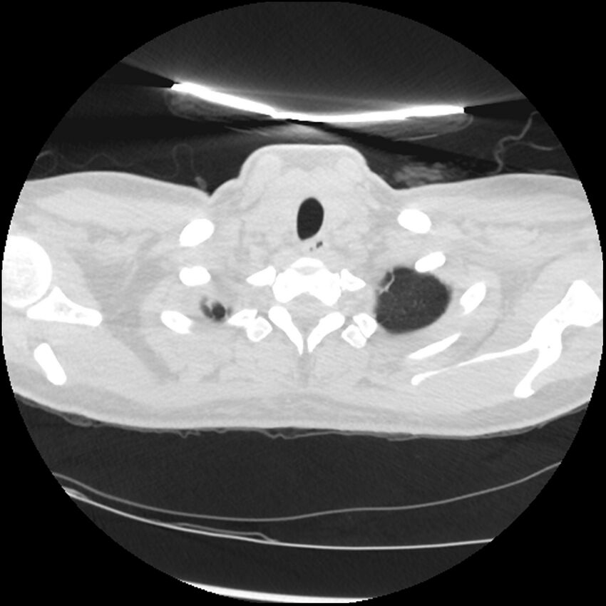 Acute lupus nephritis (Radiopaedia 45832-50107 Axial lung window 5).jpg