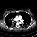 Acute myocardial infarction in CT (Radiopaedia 39947-42415 Axial C+ arterial phase 57).jpg