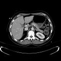 Acute myocardial infarction in CT (Radiopaedia 39947-42415 Axial C+ portal venous phase 39).jpg