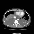 Acute myocarditis (Radiopaedia 55988-62613 Axial C+ portal venous phase 6).jpg