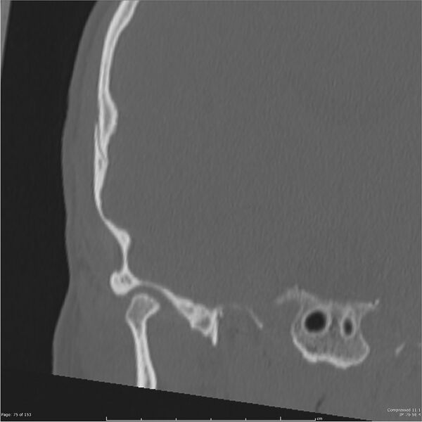 File:Acute otomastoiditis (Radiopaedia 28276-28512 Coronal PTB bone window reformat 6).jpg