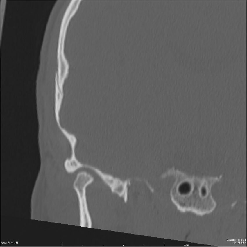 Acute otomastoiditis (Radiopaedia 28276-28512 Coronal PTB bone window reformat 6).jpg