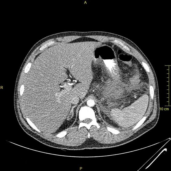 File:Acute pancreatitis (Radiopaedia 23231-23290 Axial C+ arterial phase 3).JPG