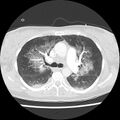 Acute pulmonary edema on CT (Radiopaedia 33582-34672 Axial lung window 19).jpg