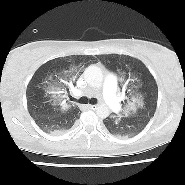 File:Acute pulmonary edema on CT (Radiopaedia 33582-34672 Axial lung window 19).jpg