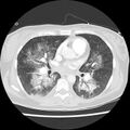 Acute pulmonary edema on CT (Radiopaedia 33582-34672 Axial lung window 27).jpg