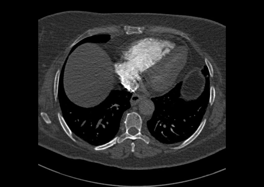 Acute pulmonary embolism (Radiopaedia 29938-30466 Axial C+ CTPA 167).jpg