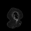 Acute pyelonephritis (Radiopaedia 25657-25837 Coronal renal parenchymal phase 10).jpg
