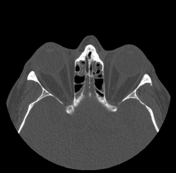 File:Acute sinusitis (Radiopaedia 23161-23215 Axial bone window 50).jpg