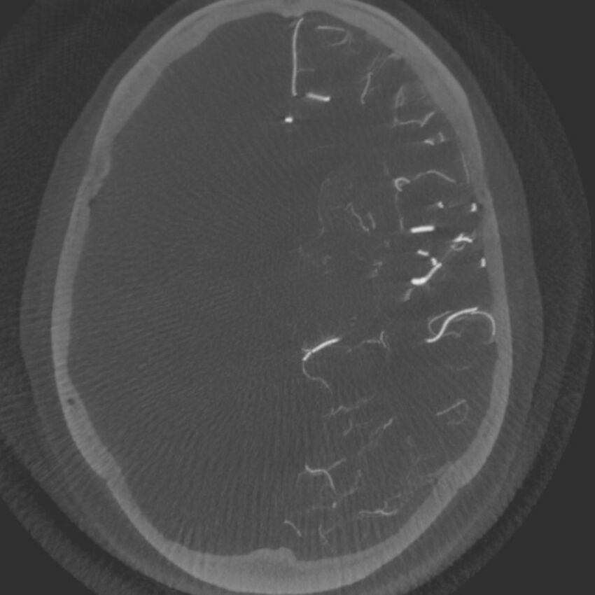 Acute subarachnoid hemorrhage and accessory anterior cerebral artery (Radiopaedia 69231-79010 C 35).jpg