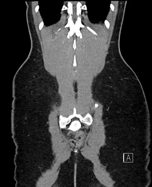 File:Acute uncomplicated appendicitis (Radiopaedia 61374-69304 Coronal C+ portal venous phase 94).jpg