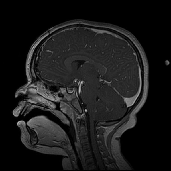 File:Adamantinomatous craniopharyngioma (Radiopaedia 77407-89529 H 65).jpg