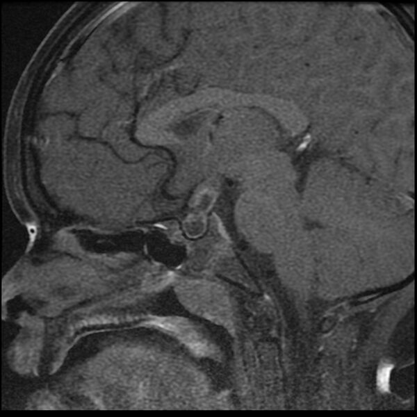 File:Adamantinomatous craniopharyngioma (Radiopaedia 77407-89529 Sagittal T1 C+ fat sat 9).jpg