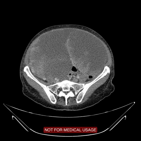 File:Adenocarcinoma of the cervix (Radiopaedia 28373-28616 Axial C+ portal venous phase 13).jpg