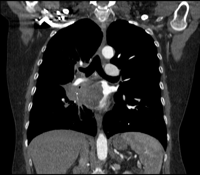 File:Adenocarcinoma of the lung (Radiopaedia 44205-47803 Coronal C+ portal venous phase 50).jpg