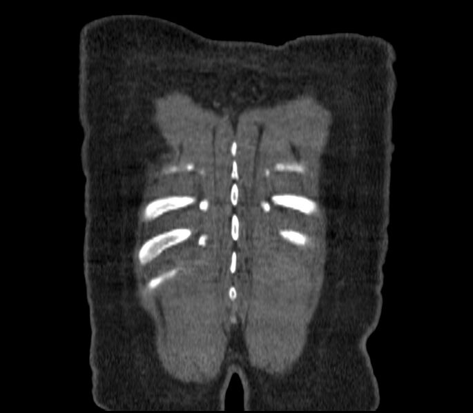 File:Adenocarcinoma of the lung (Radiopaedia 44205-47803 Coronal C+ portal venous phase 96).jpg