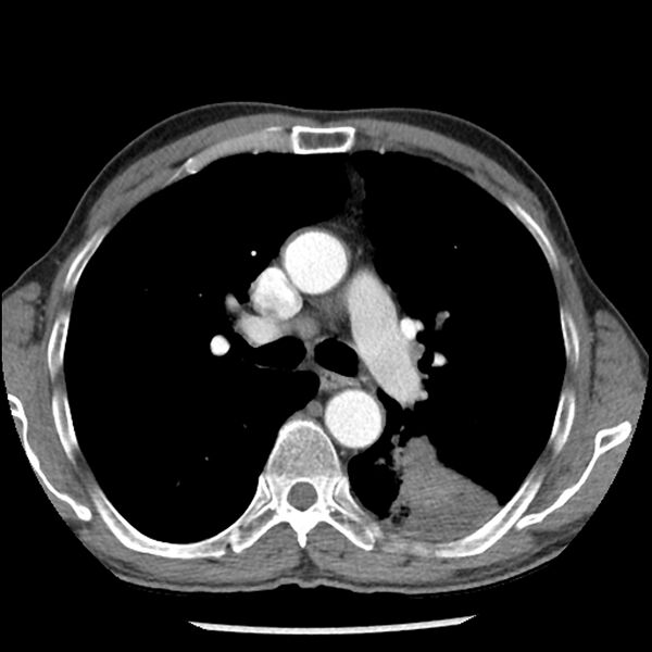 File:Adenocarcinoma of the lung - micropapillary predominant (Radiopaedia 42446-45563 Axial C+ portal venous phase 30).jpg