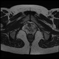 Adenoma malignum of the cervix (Radiopaedia 24460-24765 C 26).jpg