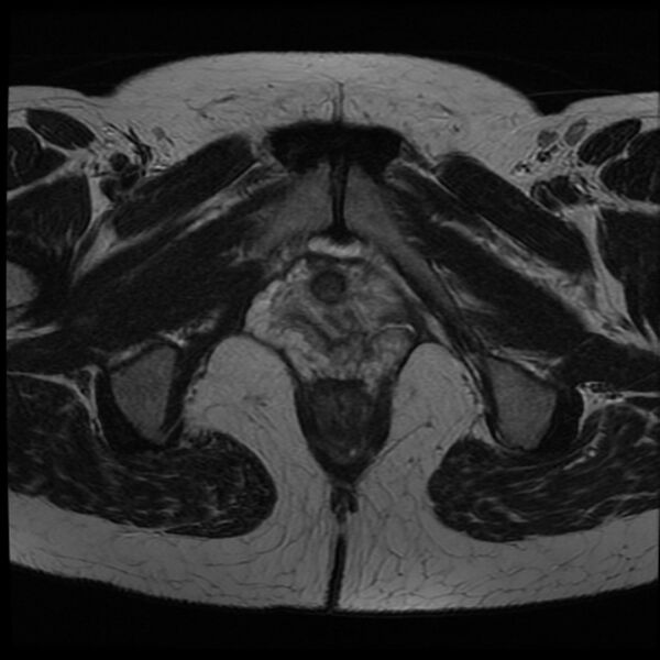 File:Adenoma malignum of the cervix (Radiopaedia 24460-24765 C 26).jpg