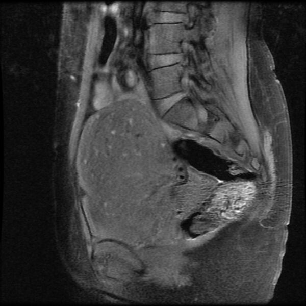 File:Adenomyosis on MRI (Radiopaedia 29328-29780 Sagittal T1 fat sat 6).jpg