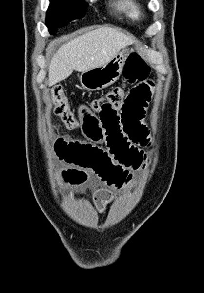 File:Adhesional small bowel obstruction (Radiopaedia 58900-66131 Coronal C+ portal venous phase 76).jpg