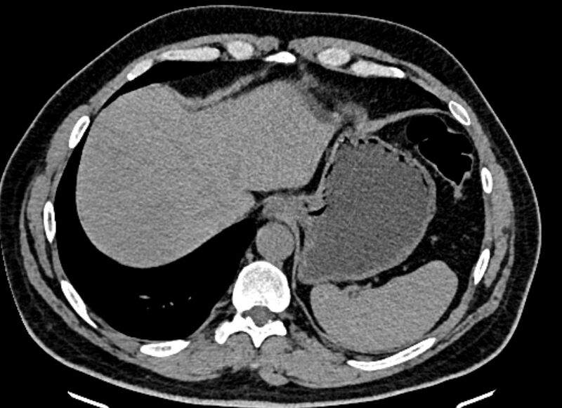 File:Adrenal metastases (Radiopaedia 73082-83791 Axial non-contrast 24).jpg