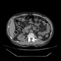 Adrenal myelolipoma (Radiopaedia 41843-44834 Axial non-contrast 32).jpg