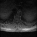 Aggressive vertebral hemangioma (Radiopaedia 39937-42404 Axial T1 C+ fat sat 13).png